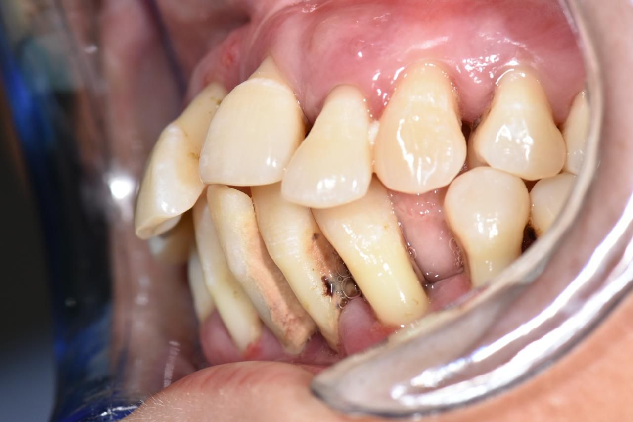 Periodontitis