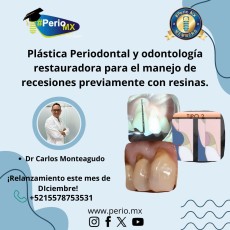 Plástica Periodontal y odontología restauradora para el manejo de recesiones previamente con resinas.